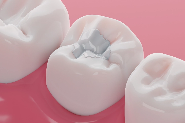Tooth-colored composite filling being applied in Surrey dental clinic