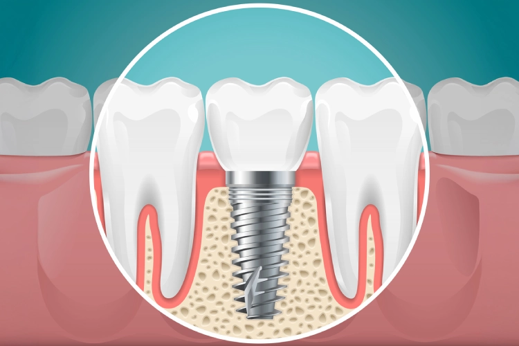 • Implant-supported crown being placed at Surrey clinic