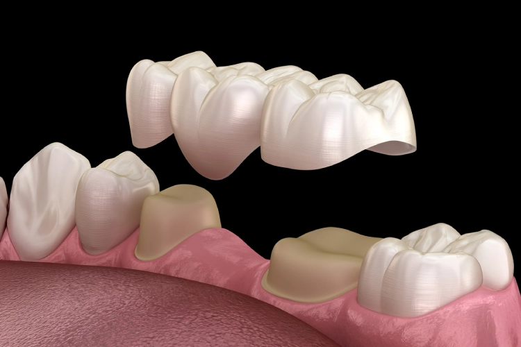 Close-up of porcelain dental bridge replacing missing teeth