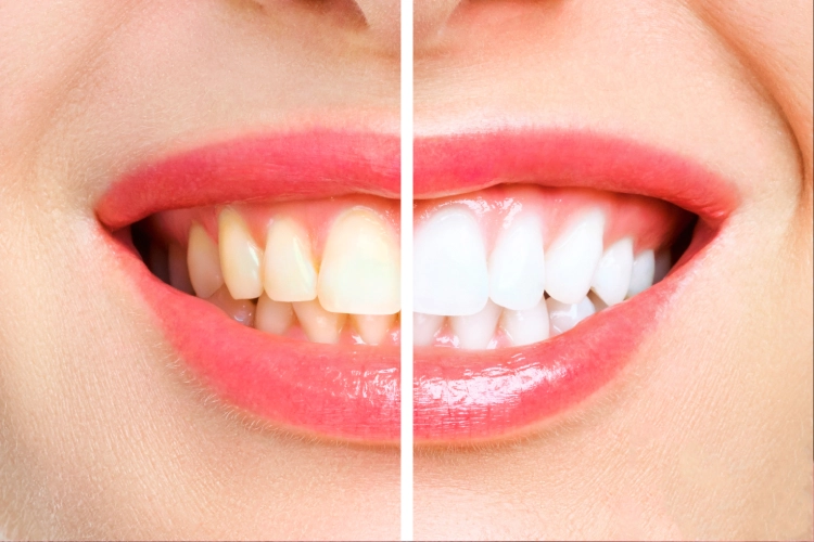 Before and after results of teeth whitening in Surrey